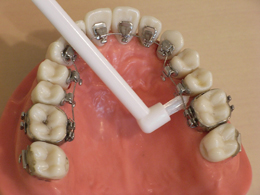 奥歯の装置の間の清掃